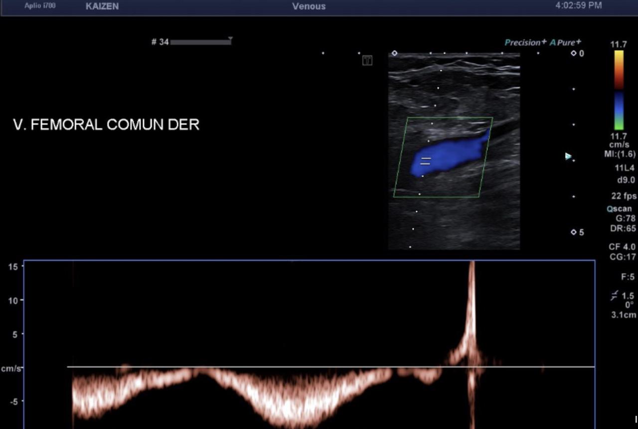 Imagen de Doppler vascular