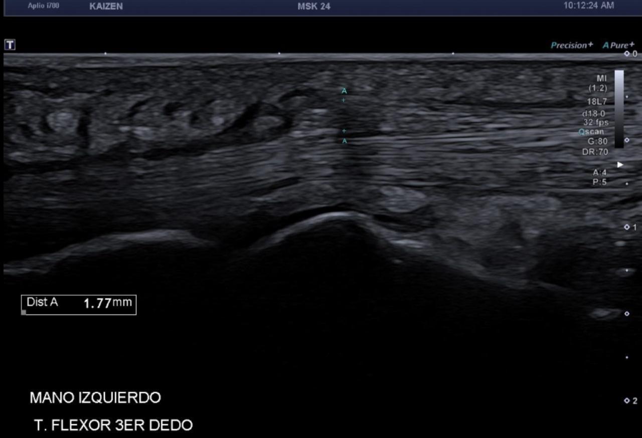 Imagen de ecografía musculoesquelética