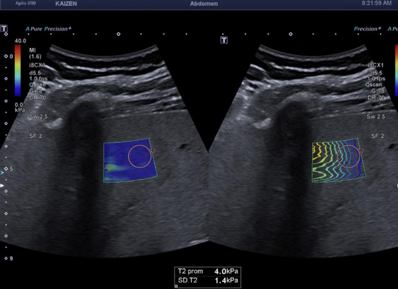 Imagen de Esteatosis - Elastografía Hepática